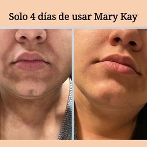 TimeWise® Microdermabrasion Plus